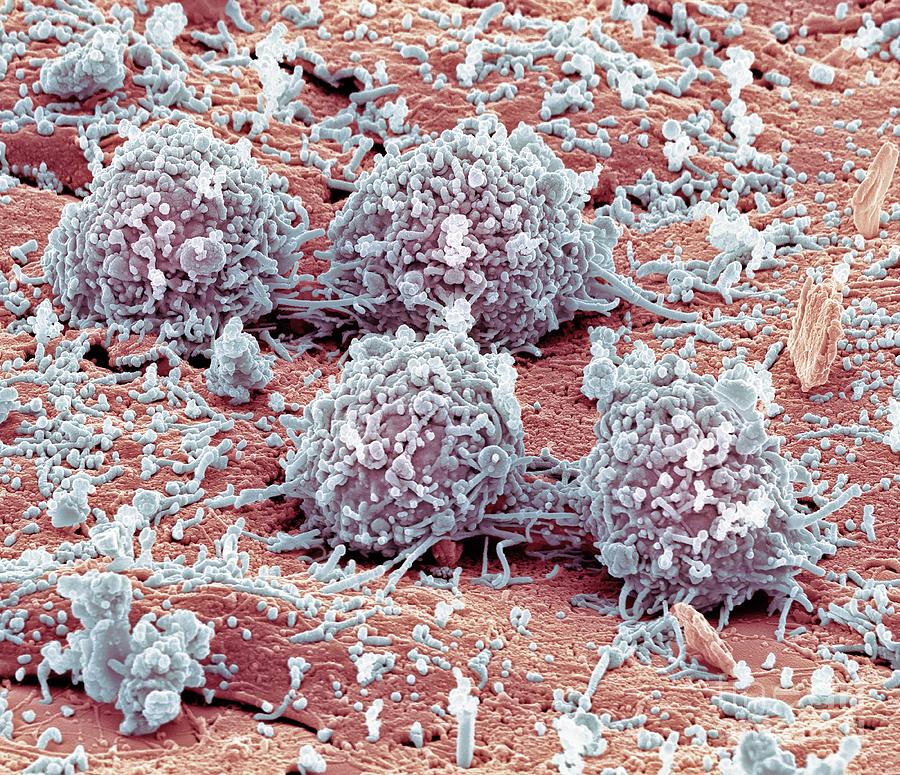 Dividing Colorectal Cancer Cells Photograph By Steve Gschmeissnerscience Photo Library Pixels