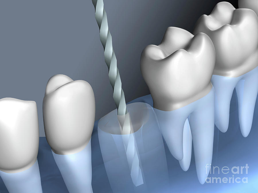 Drilling For A Dental Implant #1 Photograph by Fernando Da Cunha/science Photo Library