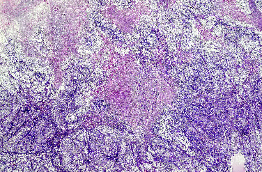 Endodermal Sinus Tumour Photograph By Nigel Downer Science Photo Library Pixels