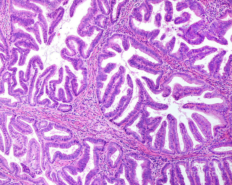 Endometroid Carcinoma #1 by Jose Calvo / Science Photo Library