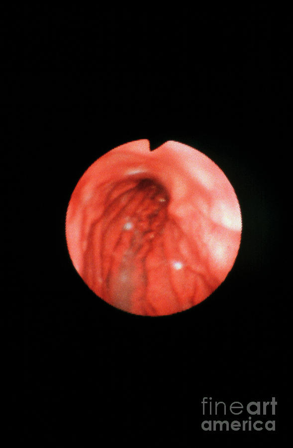 Fundus Photograph - Endoscope Image Of Normal Fundus Of Stomach #1 by Cnri/science Photo Library