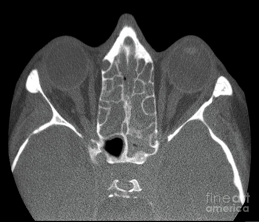 Black And White Photograph - Ethmoid Sinus Infection #1 by Zephyr/science Photo Library