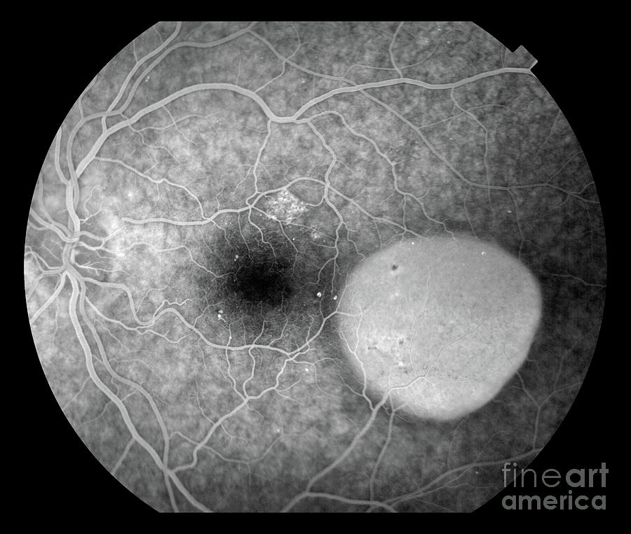 Eye Damage Due To Diabetes #1 Photograph By Alan Frohlichstein Science 