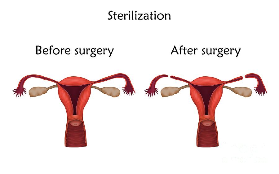Female Sterilization Photograph By Veronika Zakharovascience Photo Library 