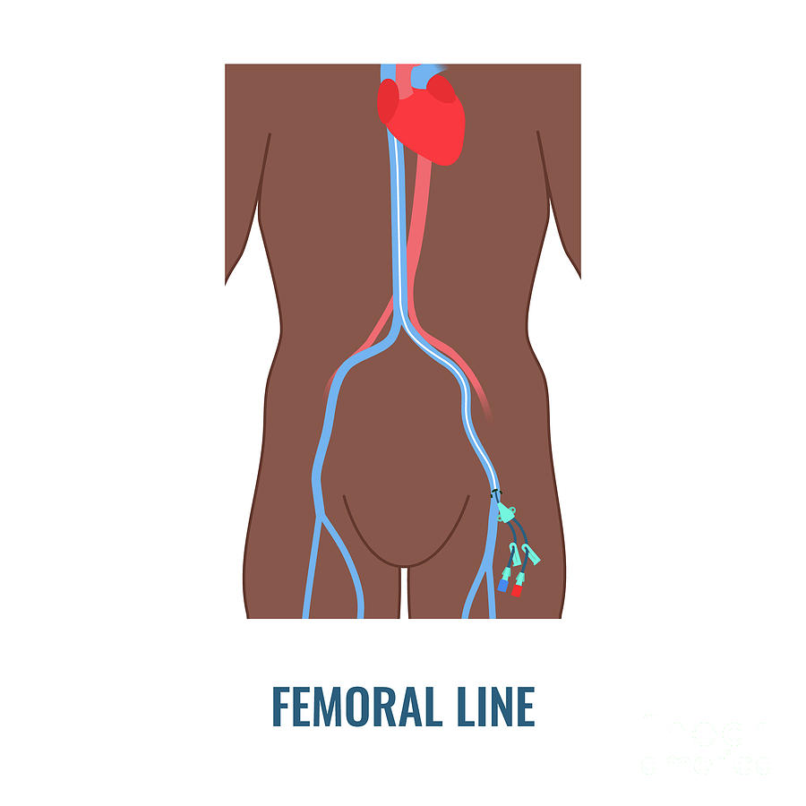 Femoral Central Venous Catheter #1 by Art4stock/science Photo Library