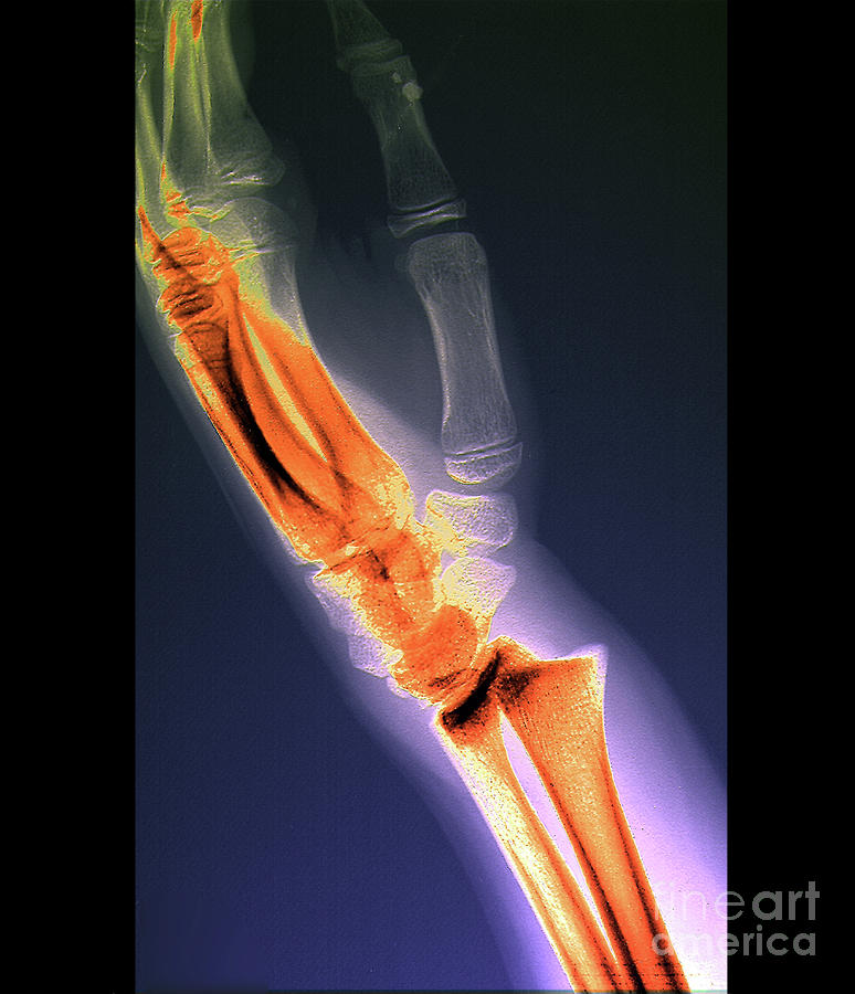 Fractured Wrist Photograph By Zephyrscience Photo Library Fine Art America 1008