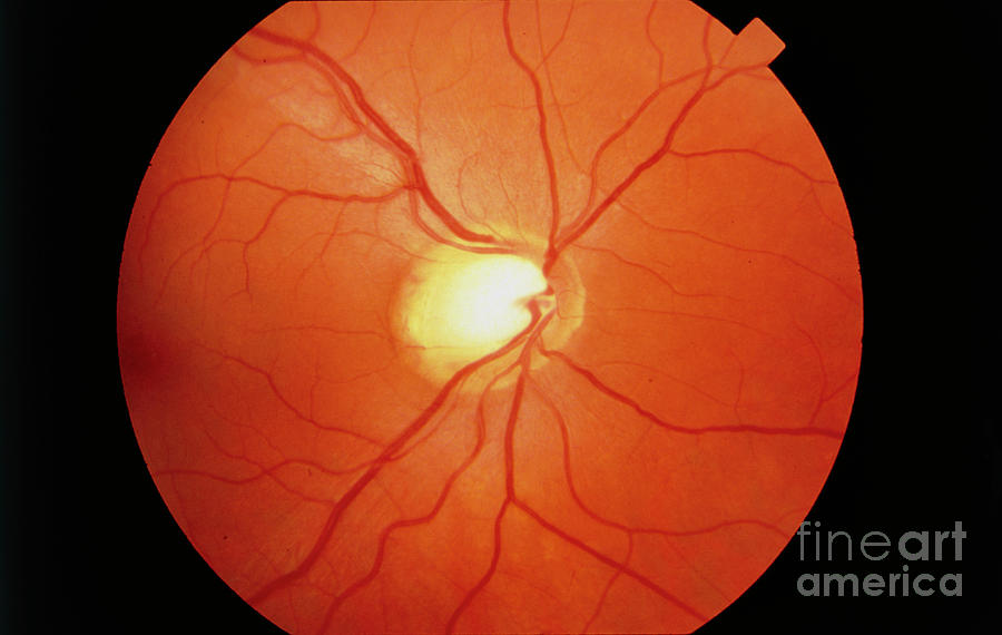 Fundus Camera Image: Cupping Of Disc In Glaucoma #1 Photograph by Western Ophthalmic Hospital/science Photo Library