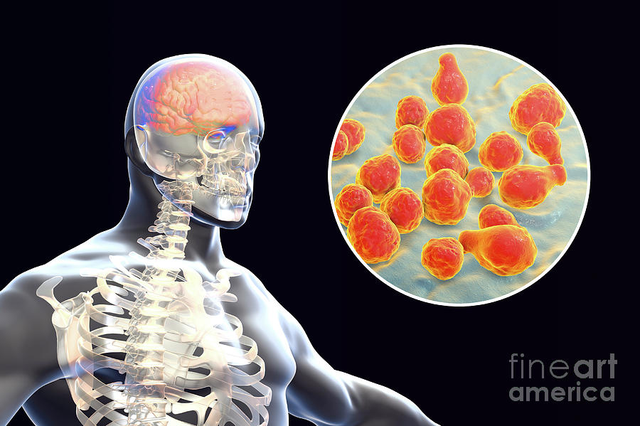 Fungal Meningitis Photograph By Kateryna Konscience Photo Library Pixels 1907