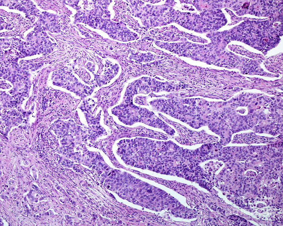 Gastric Adenocarcinoma #1 Photograph by Jose Calvo / Science Photo Library