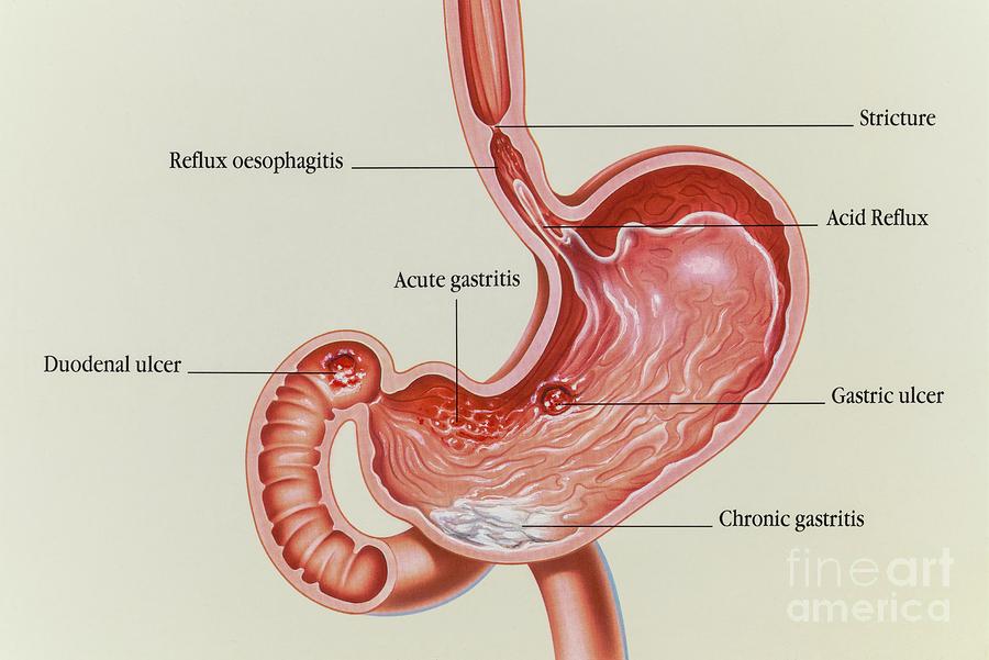 gastric-and-duodenal-ulcers-and-acid-reflux-photograph-by-john-bavosi