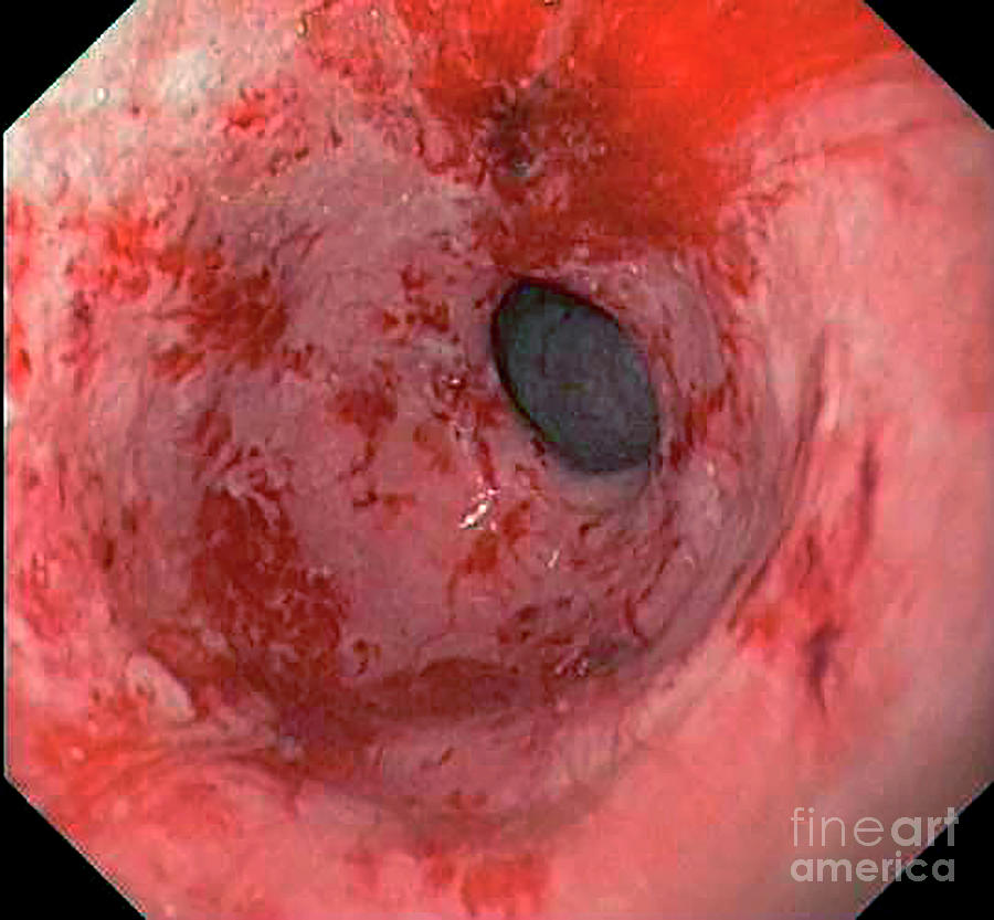 Gastric Antral Vascular Ectasia Photograph - Gastric Antral Vascular Ectasia #1 by Gastrolab/science Photo Library