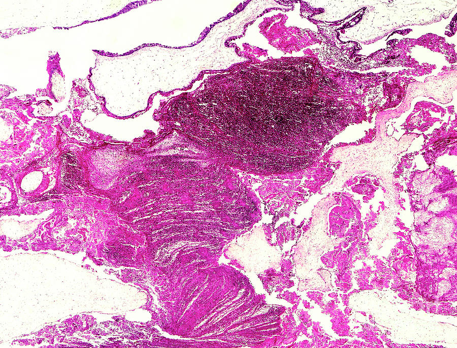 Gestational Trophoblastic Disease Photograph by Nigel Downer/science ...