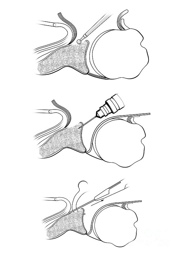 Glenoid Cavity Shoulder Surgery Photograph by Maurizio De Angelis ...