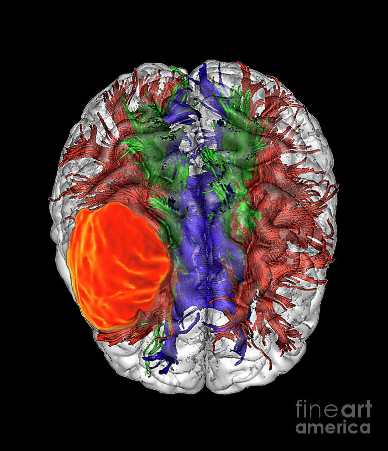 Glioblastoma Brain Cancer #1 Photograph by Zephyr/science Photo Library