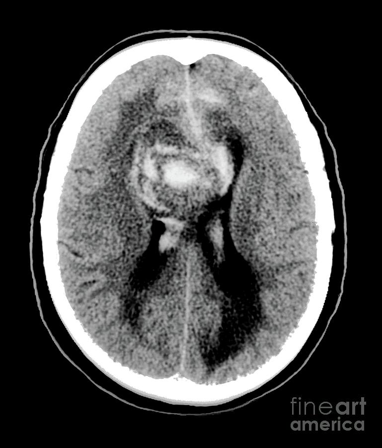 Black And White Photograph - Glioblastoma Cancerous Brain Tumour #1 by Zephyr/science Photo Library