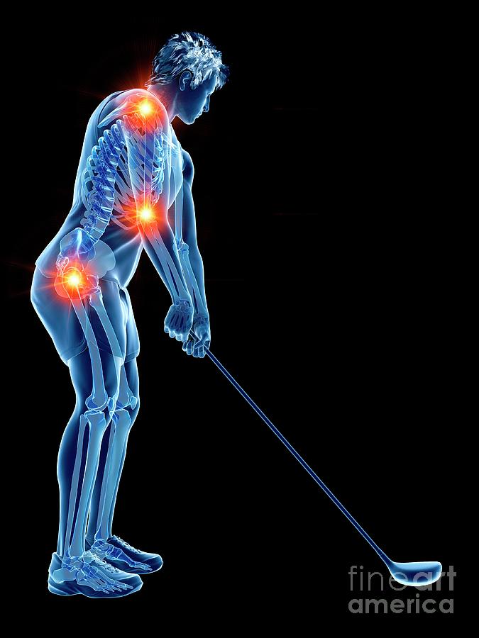 Golf Player With Painful Joints #1 Photograph by Sebastian Kaulitzki/science Photo Library