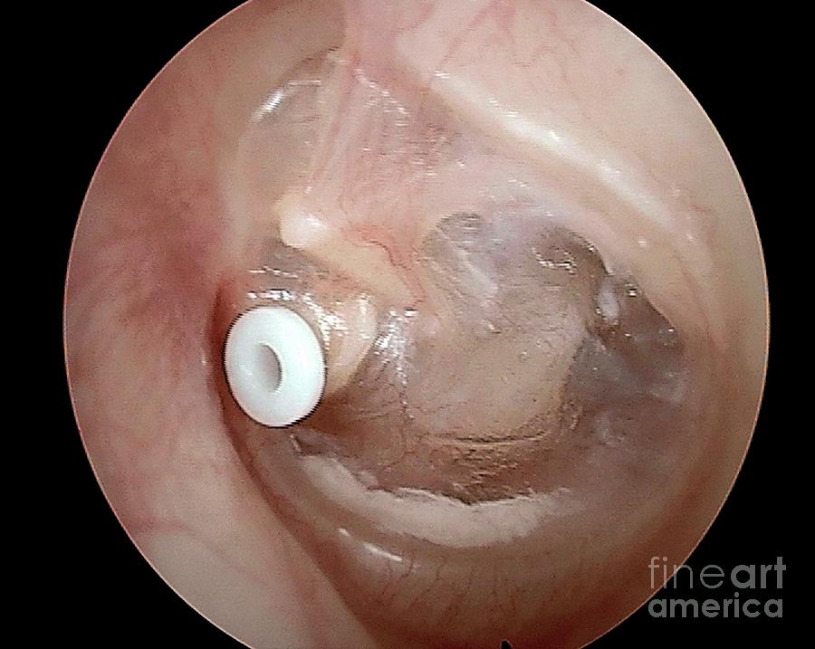 Device Photograph - Grommet In The Eardrum #1 by Professor Tony Wright, Institute Of Laryngology & Otology/science Photo Library