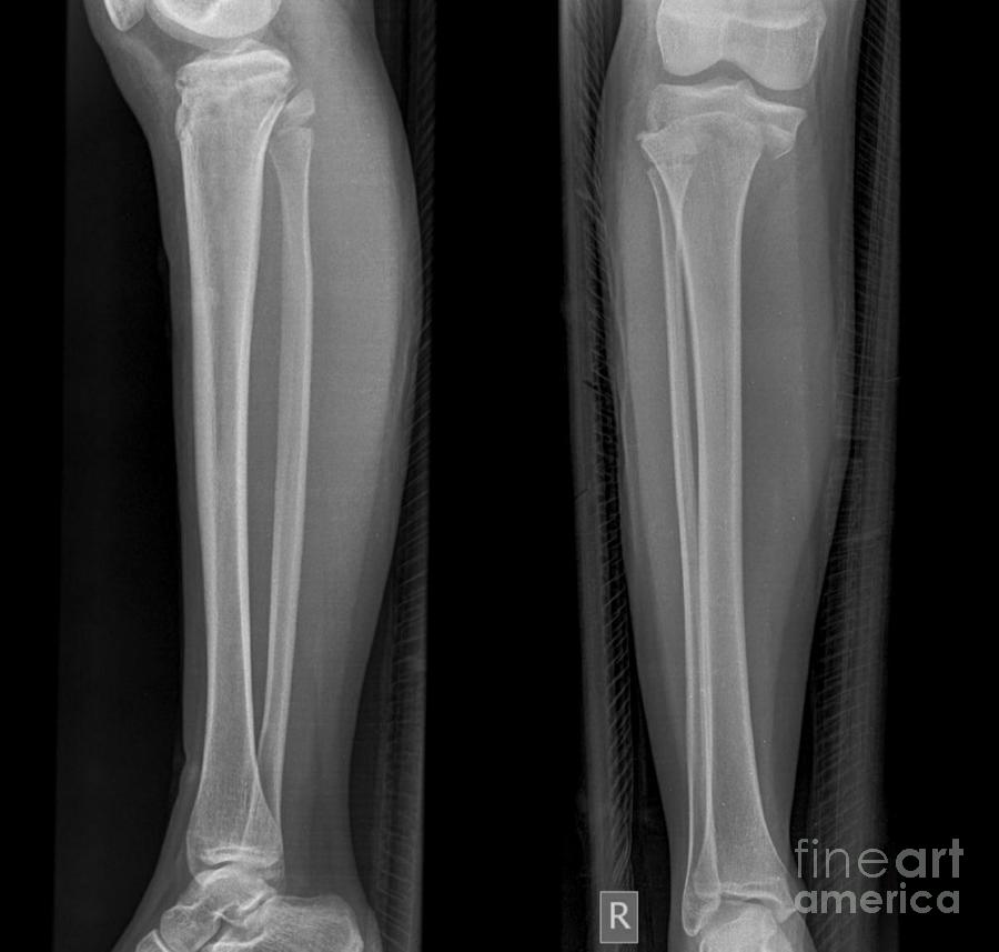Growth Plate Fracture Photograph by Rajaaisya/science Photo Library Fine Art America