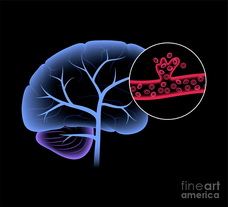 Haemorrhagic Stroke Photograph by Pikovit / Science Photo Library ...