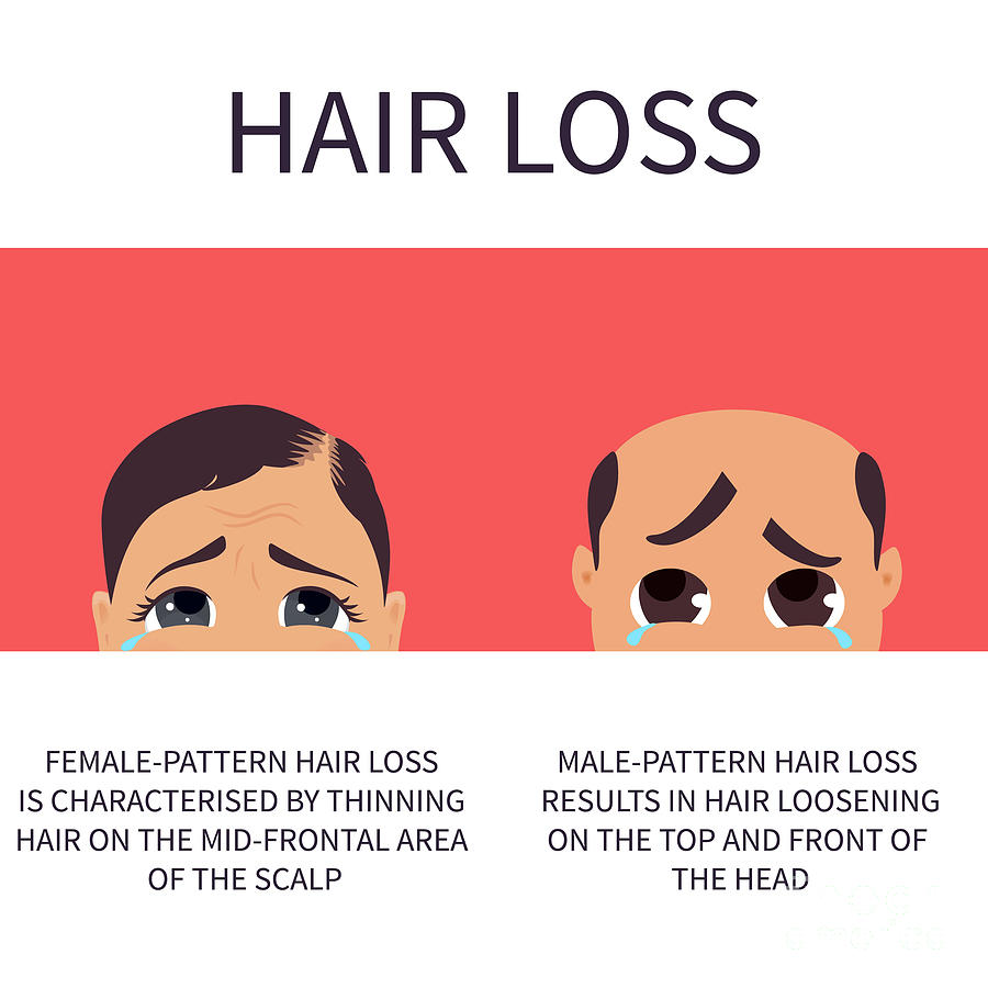 Hair Loss In Men And Women #1 Photograph by Art4stock/science Photo Library