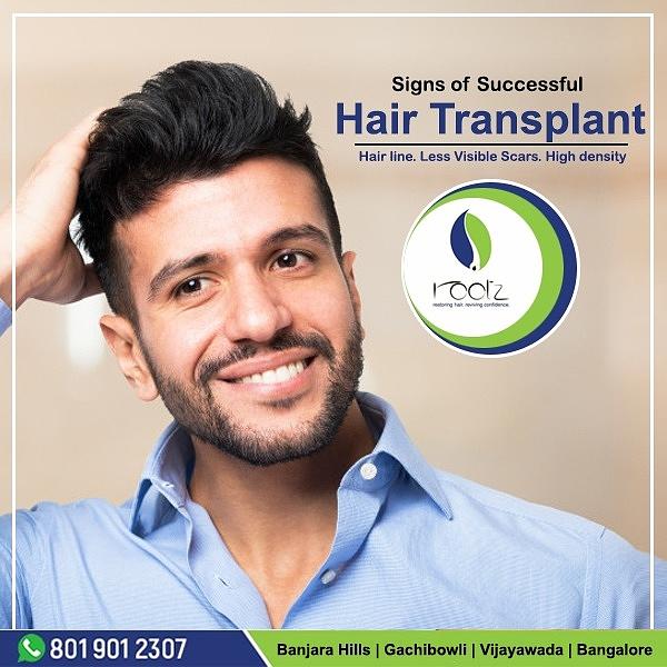 Hair Transplant In Hyderabad Photograph by Rootz Hair - Pixels