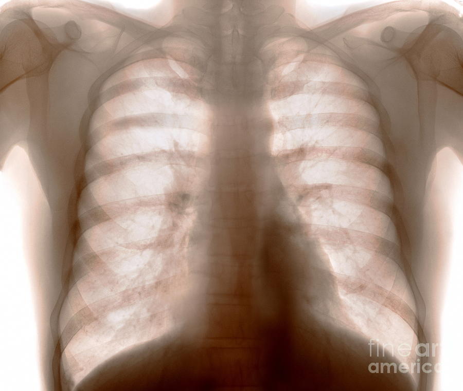Healthy Chest Xray Photograph by Gustoimages/science Photo Library