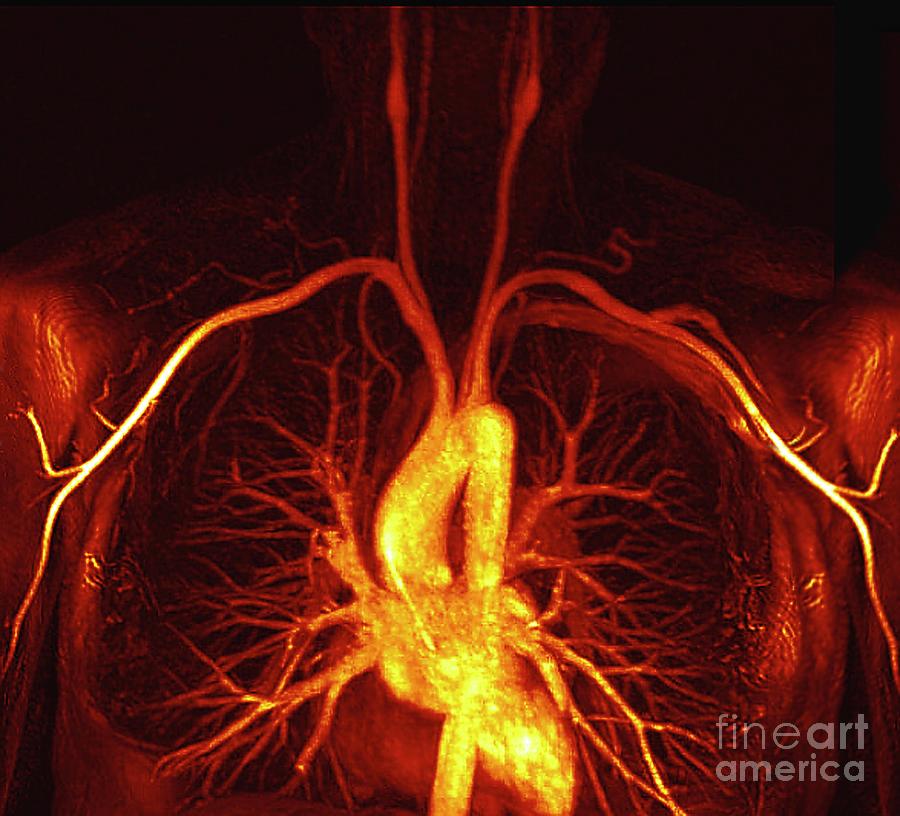 Heart And Torso Blood Vessels #1 Photograph by Zephyr/science Photo Library