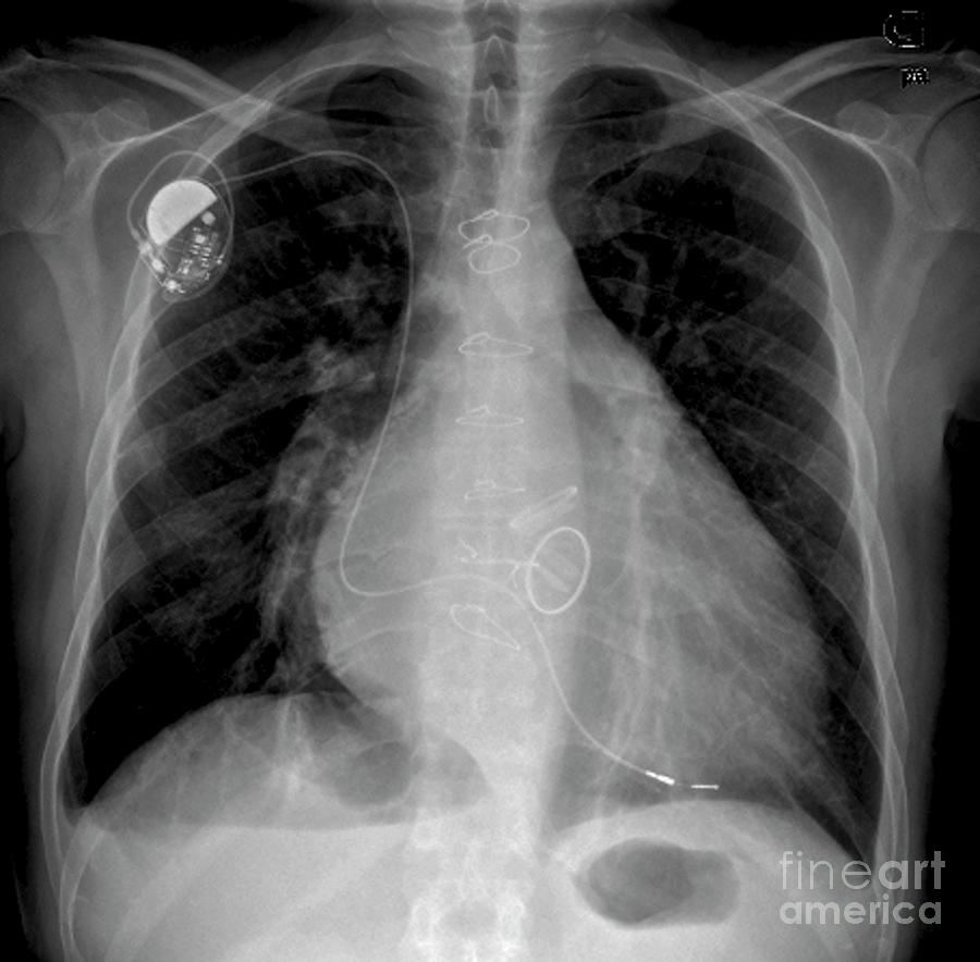 Heart Failure #1 Photograph by Zephyr/science Photo Library