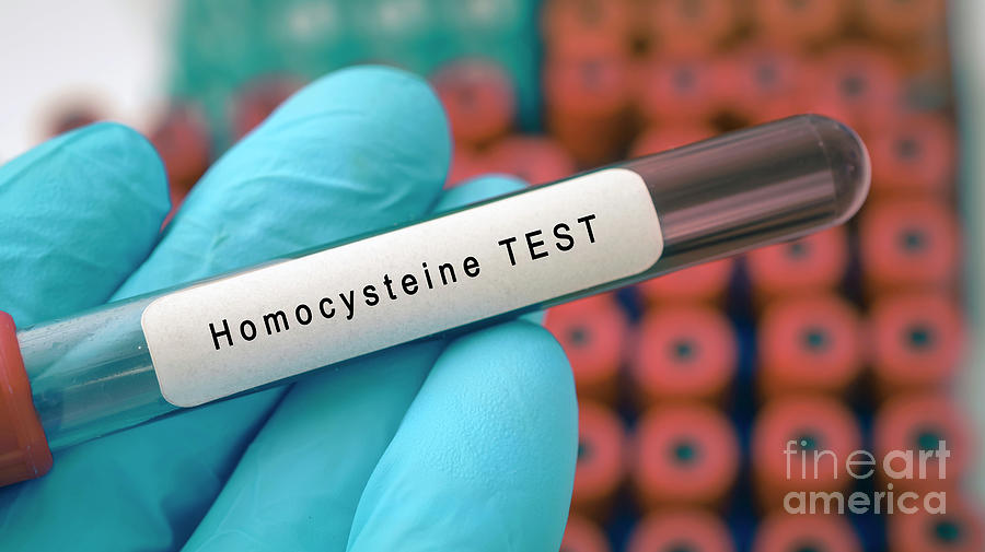 Homocysteine Blood Test #1 Photograph by Wladimir Bulgar/science Photo Library