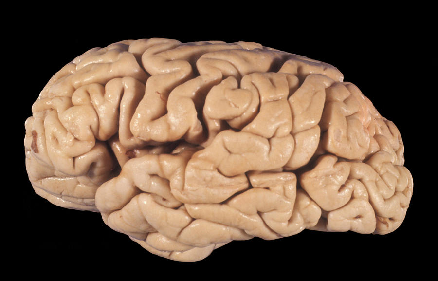 Human Brain, Cortical Atrophy #1 Photograph by Jose Luis Calvo