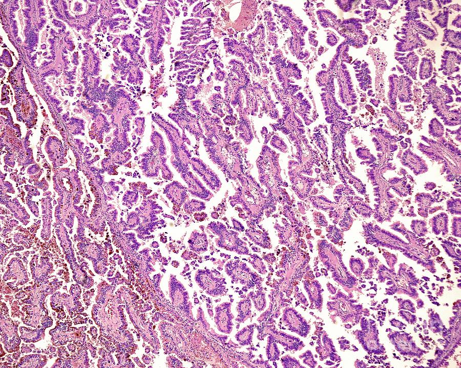 Human Renal Cell Carcinoma Photograph By Jose Calvo Science Photo Library Pixels 9248