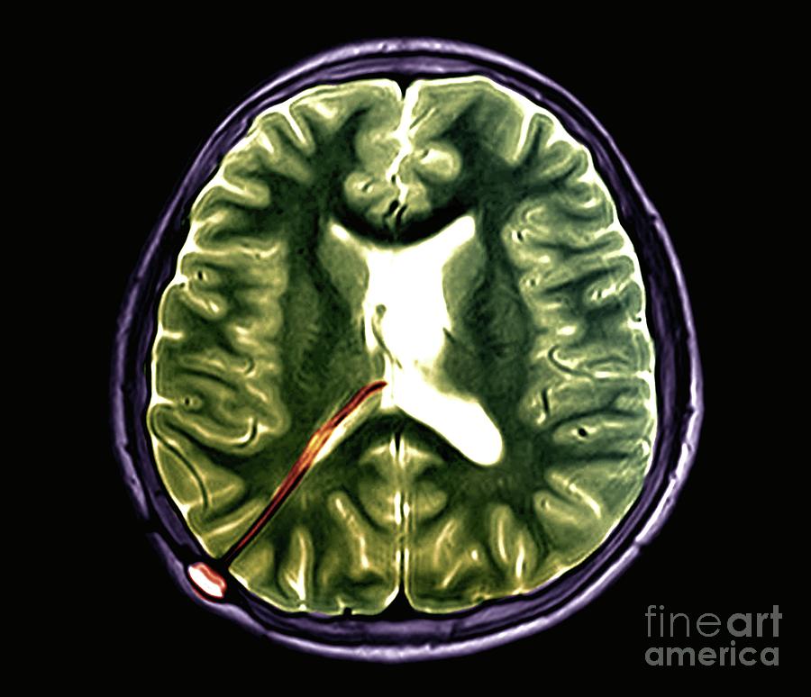 Hydrocephalus Treatment 0235