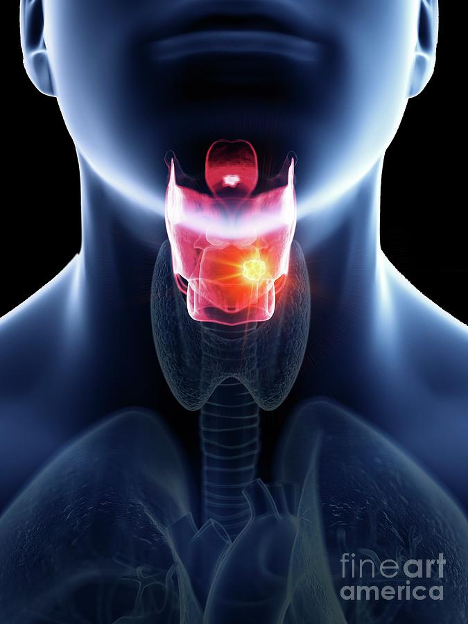 Illustration Of A Man's Larynx Cancer #1 by Sebastian Kaulitzki/science ...