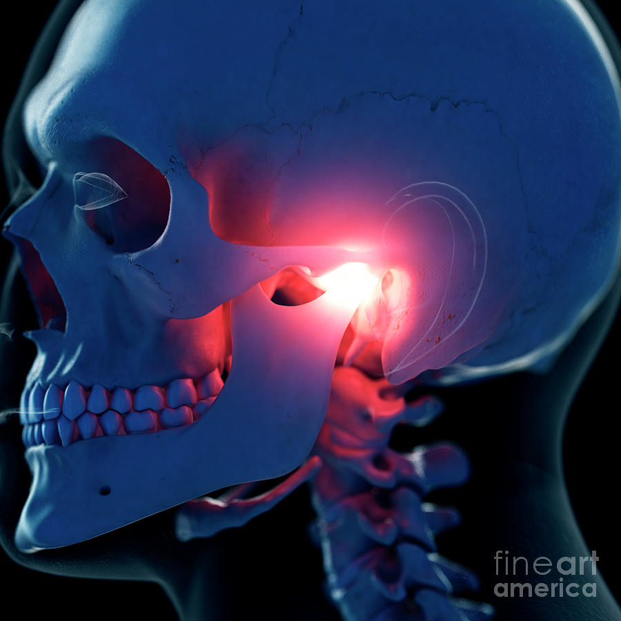 Skeleton Photograph - Illustration Of A Painful Temporomandibular Joint #1 by Sebastian Kaulitzki/science Photo Library