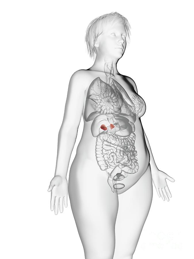 3d Photograph - Illustration Of An Obese Womans Adrenal Glands #1 by Sebastian Kaulitzki/science Photo Library