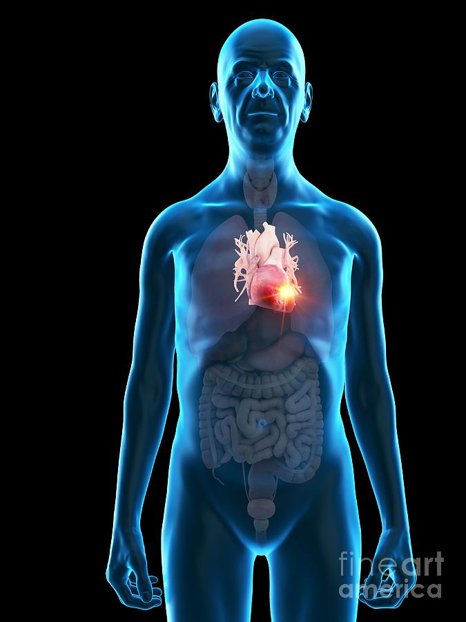 Illustration Of An Old Mans Heart Tumour #1 Photograph by Sebastian Kaulitzki/science Photo Library