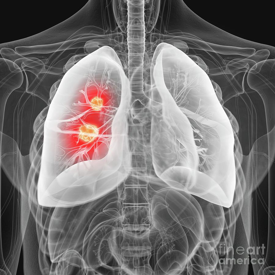 Illustration Of Lung Cancer Photograph by Sebastian Kaulitzki/science ...