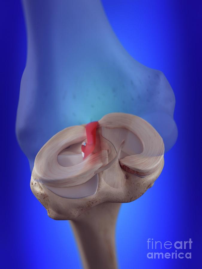 Illustration Of The Anterior Cruciate Ligament #1 Photograph by Sebastian Kaulitzki/science Photo Library