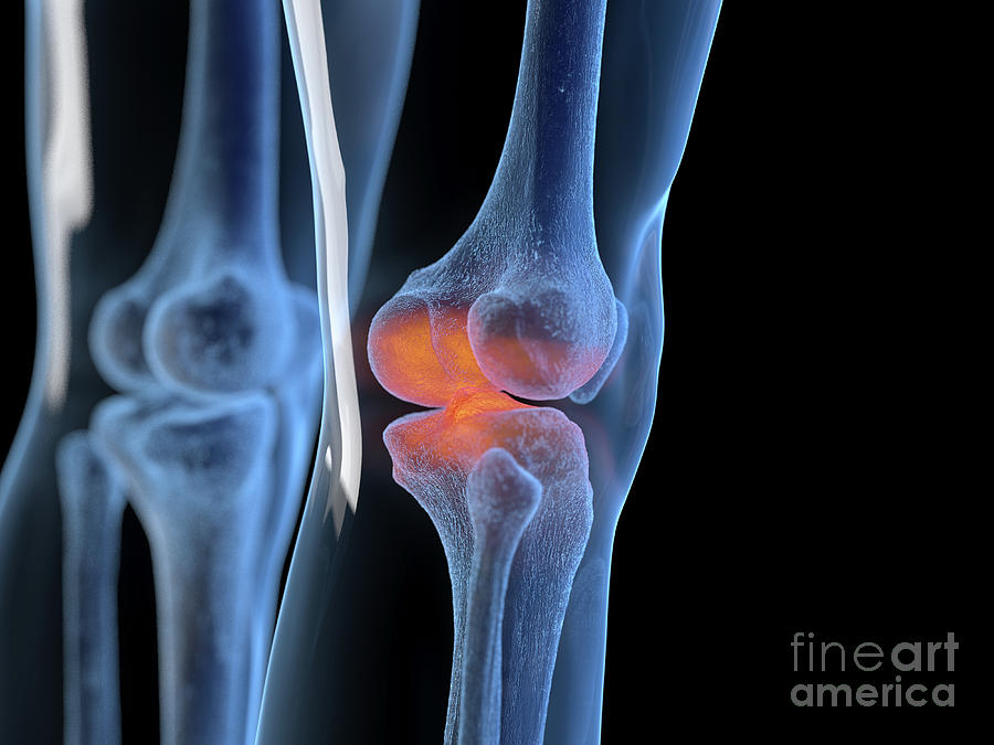 inflamed-knee-joint-photograph-by-sebastian-kaulitzki-science-photo