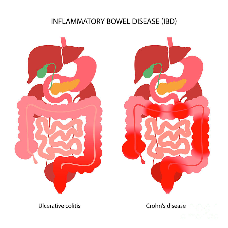 Inflammatory Bowel Disease Photograph by Pikovit / Science Photo ...