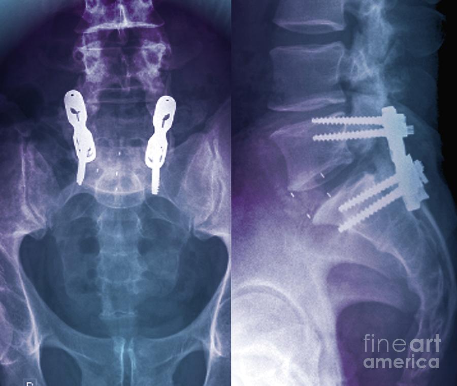 Intervertebral Fixing #1 Photograph by Zephyr/science Photo Library