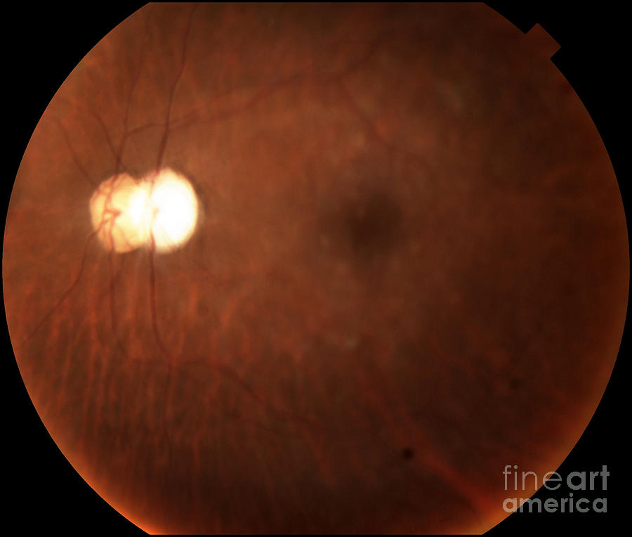 Intraocular Lens Subluxation Photograph by Alan Frohlichstein/science