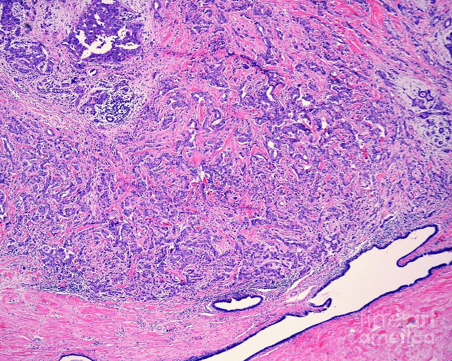 Invasive Carcinoma Of The Breast 1 Photograph By Jose Calvo science 