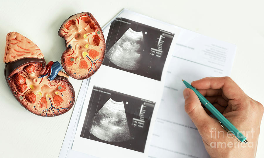 Kidney Disease #1 Photograph by Peakstock / Science Photo Library