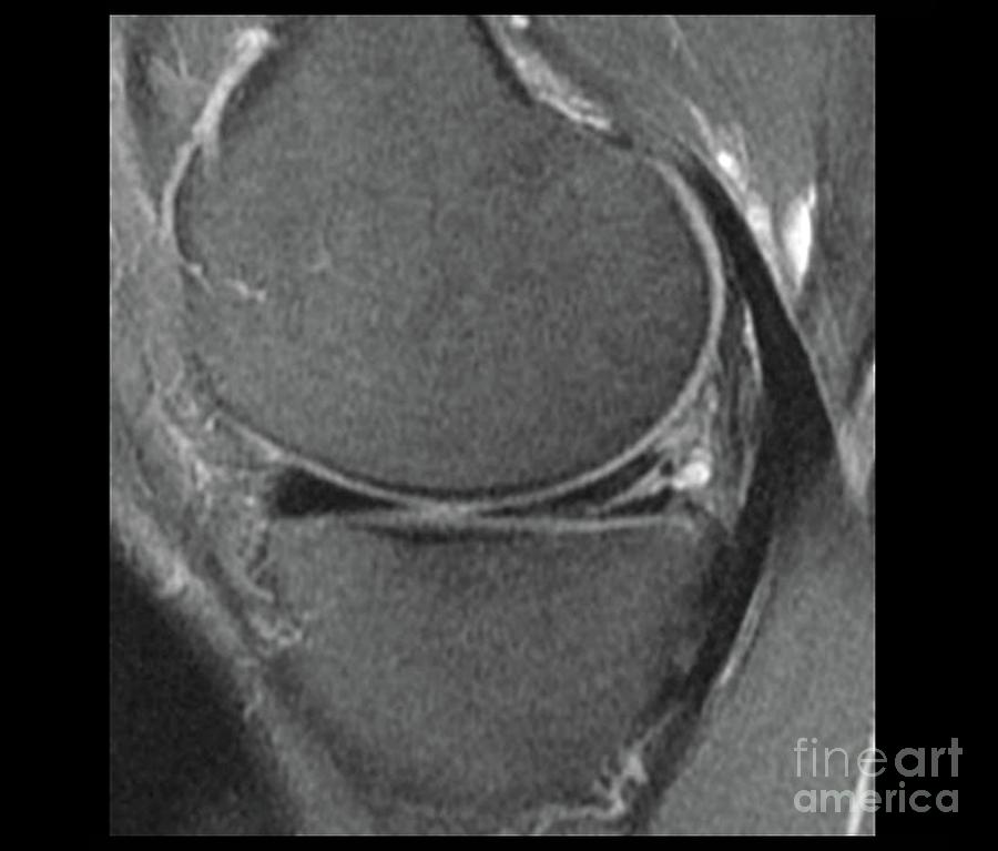 Knee Meniscus Injury #1 Photograph by Zephyr/science Photo Library