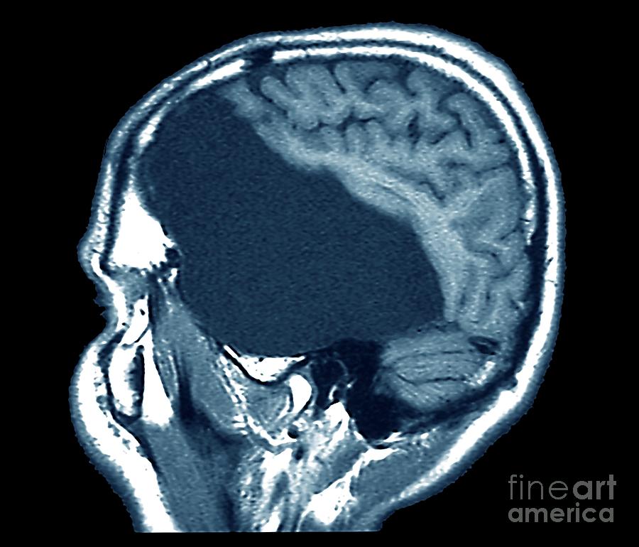 Large Arachnoid Cyst #1 Photograph by Zephyr/science Photo Library