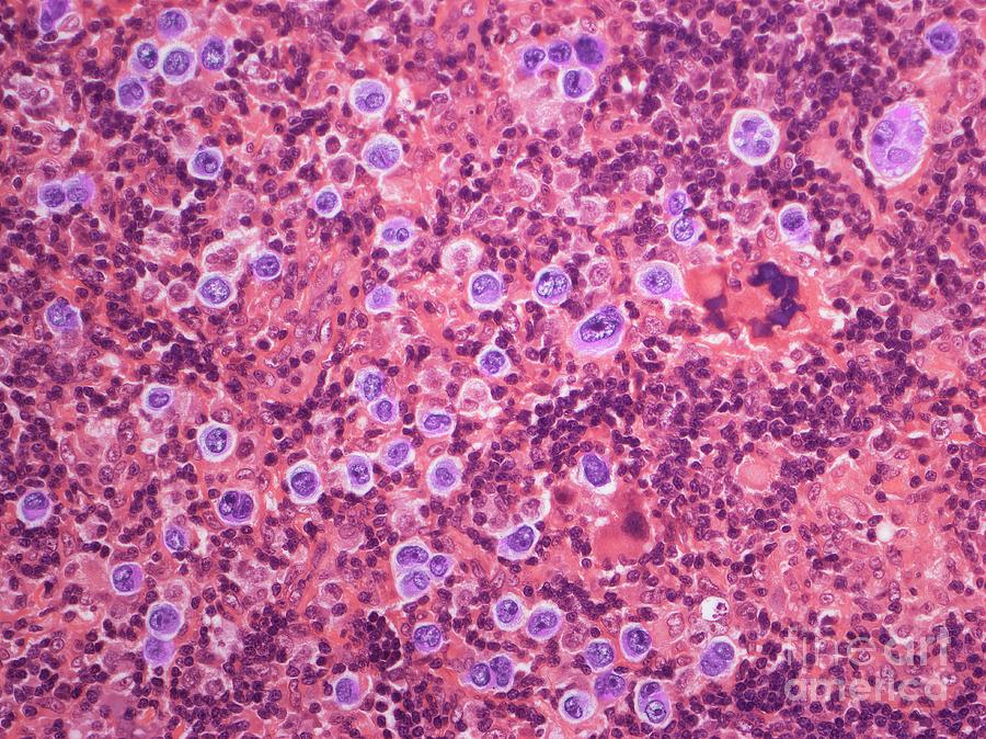 Large B Cell Lymphoma #1 Photograph by Steve Gschmeissner/science Photo Library