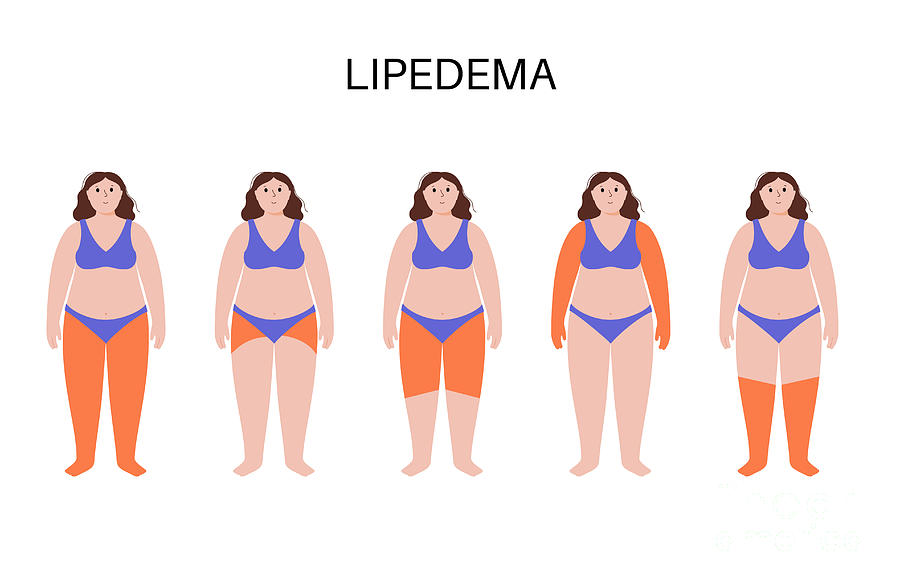 Lipoedema Fat Zones #1 Photograph by Pikovit / Science Photo Library