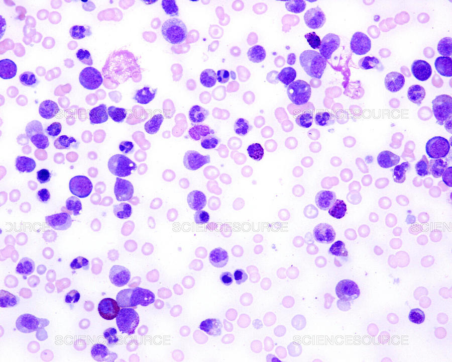 Lm Of Chronic Myeloid Leukemia #1 Photograph by Jose Luis Calvo