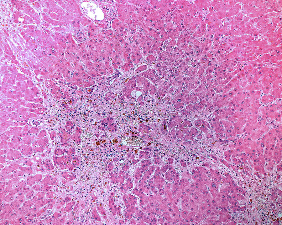 Lm Of Toxic Liver Disease #1 Photograph by Jose Luis Calvo
